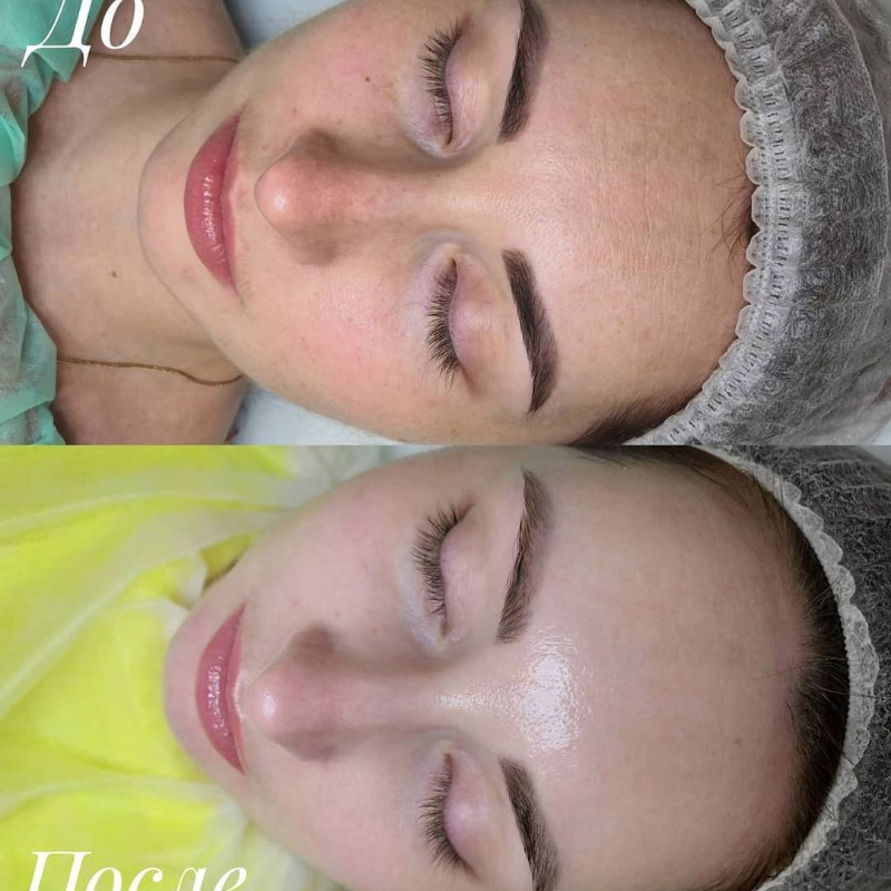 Результат косметолога Марины Заболотиной после прохождения пациентом курса Лифтингового пилинга IMAGE Skincare❤️