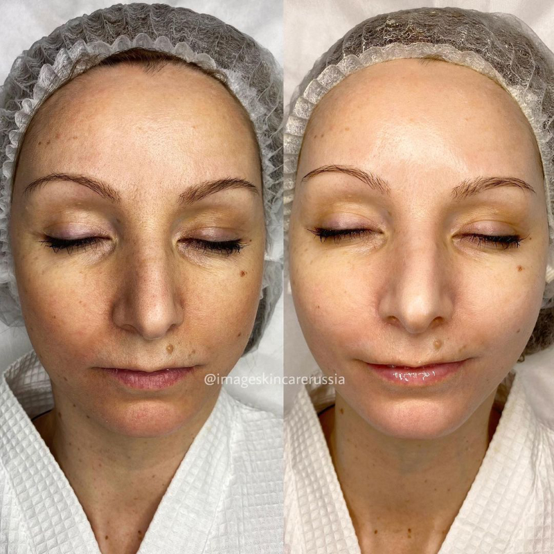 Результат всего одной процедуры фирменного Лифтингового пилинга IMAGE Skincare Signature Face Lift Solution😍