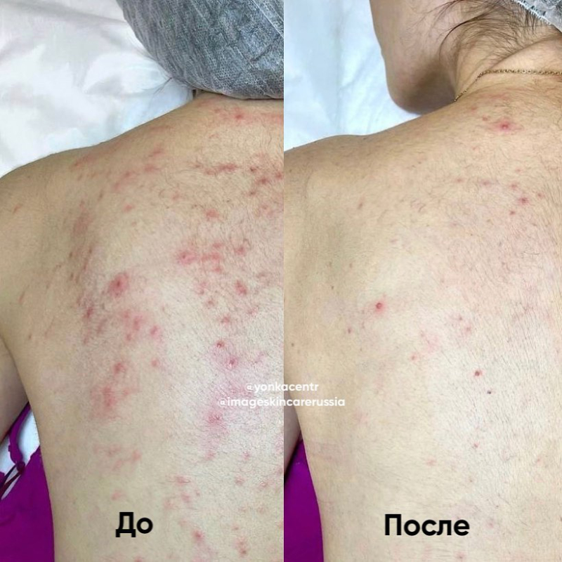 Промежуточный результат лечения акне спины от наших представителей во Владикавказе