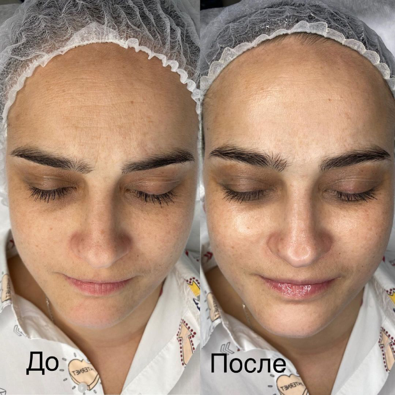 Результат «до/после» Лифтингового пилинга для лица Signature Face Lift Solution😍
