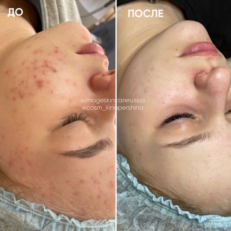Результат лечения от косметолога Ирины Першиной